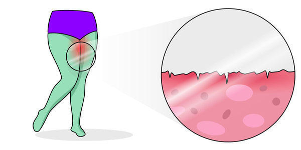 thigh chafing and chub rub and thigh rubbing causes microtears in the skin